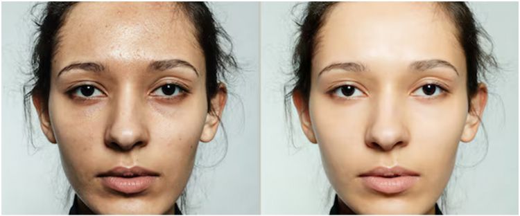 Cara mudah memudarkan dark spot akibat bekas luka atau jerawat cuma dengan 1 jenis rempah ini