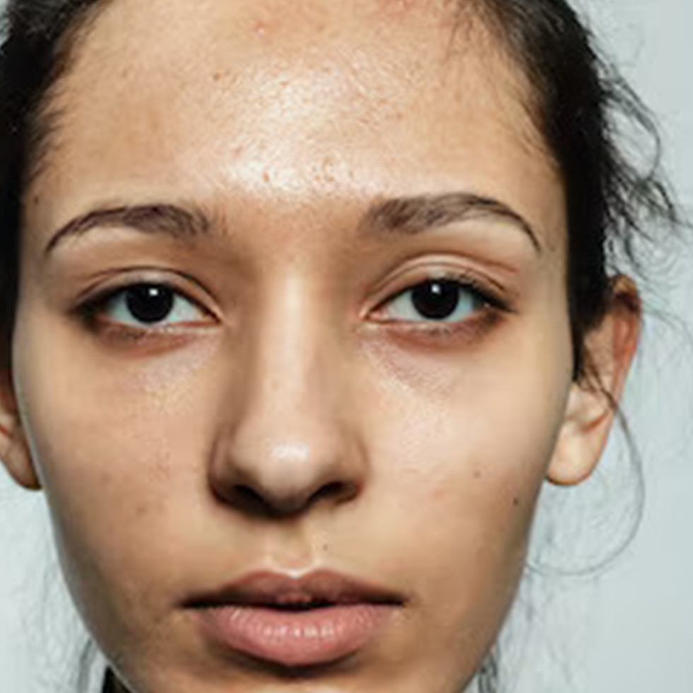 Cara mudah memudarkan dark spot akibat bekas luka atau jerawat cuma dengan 1 jenis rempah ini