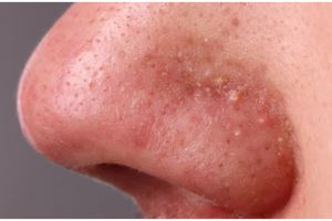 Bukan pakai air beras, ini cara kecilkan pori-pori besar tanpa iritasi cuma dengan 1 bahan minuman