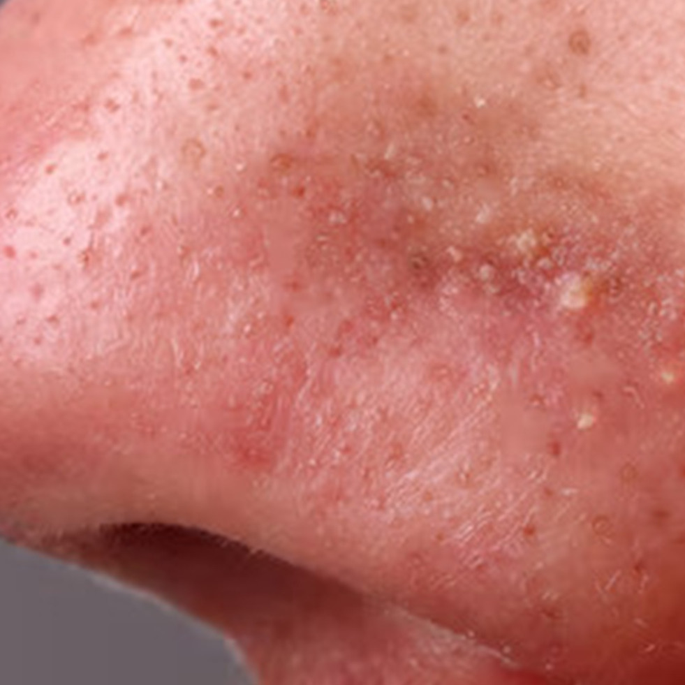 Bukan pakai air beras, ini cara kecilkan pori-pori besar tanpa iritasi cuma dengan 1 bahan minuman