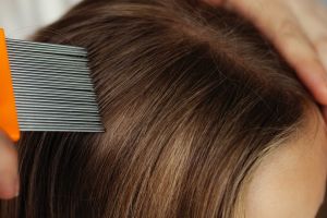 Nggak harus beli obat, begini cara menghilangan kutu rambut cuma pakai 2 bahan alami