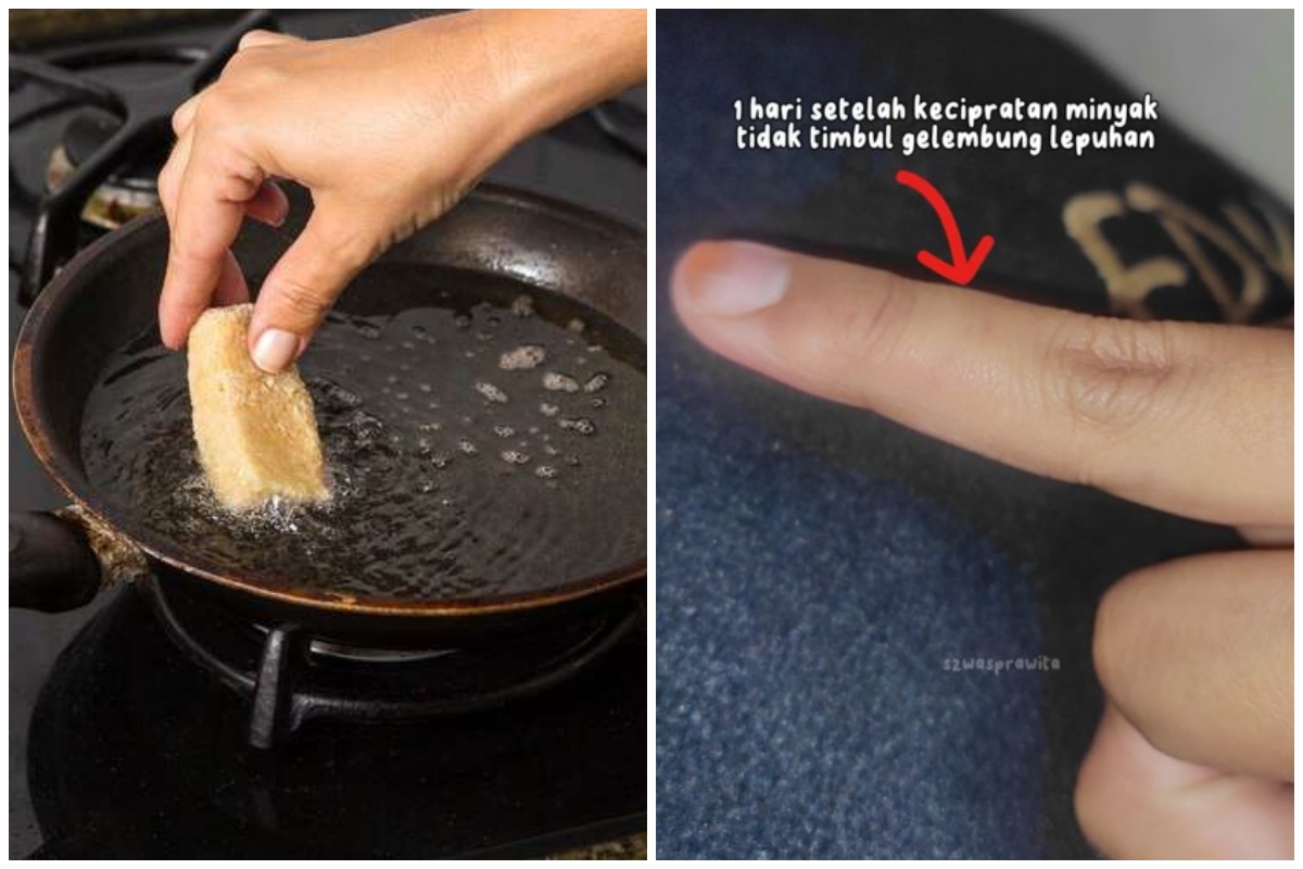 Bukan dioles pasta gigi, begini trik mudah agar tangan tak melepuh usai kena cipratan minyak panas