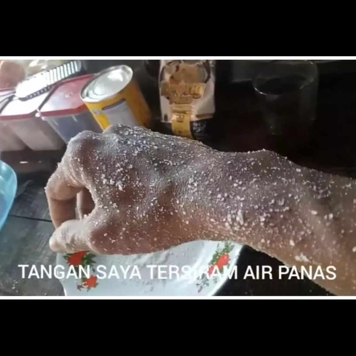 Atasi kulit tersiram air panas agar tak melepuh, cukup pakai 1 bumbu dapur ini