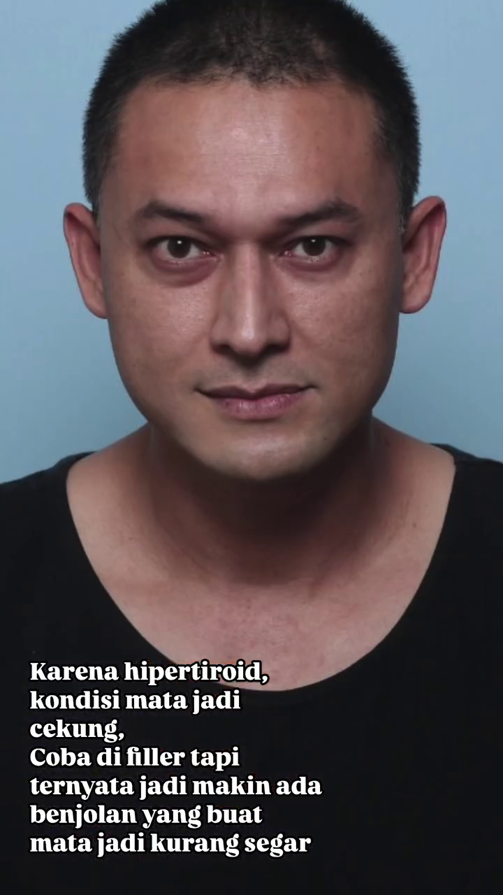 Mata cekung karena hipertiroid, 9 potret Indra Bruggman usai oplas ini dipuji makin tampan