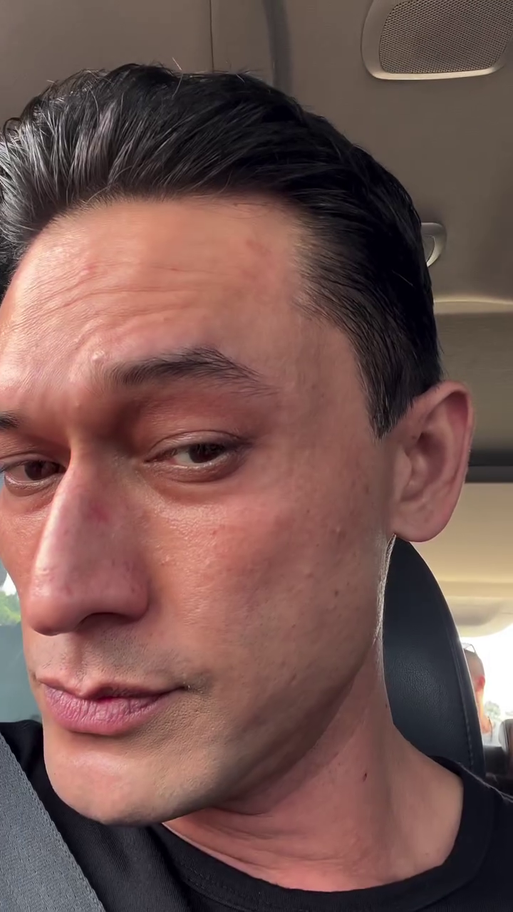 Mata cekung karena hipertiroid, 9 potret Indra Bruggman usai oplas ini dipuji makin tampan