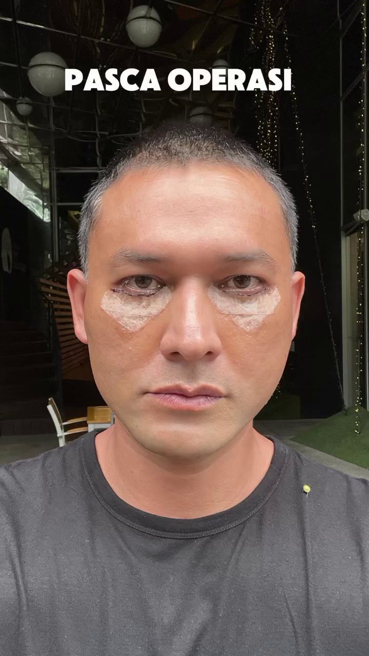 Mata cekung karena hipertiroid, 9 potret Indra Bruggman usai oplas ini dipuji makin tampan