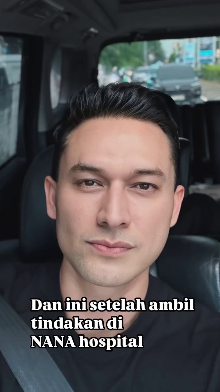 Mata cekung karena hipertiroid, 9 potret Indra Bruggman usai oplas ini dipuji makin tampan