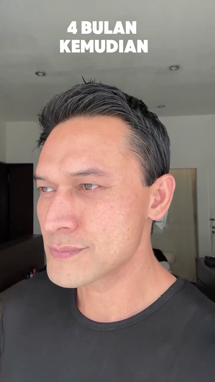 Mata cekung karena hipertiroid, 9 potret Indra Bruggman usai oplas ini dipuji makin tampan