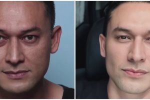 Mata cekung karena hipertiroid, 9 potret Indra Bruggman usai oplas ini dipuji makin tampan