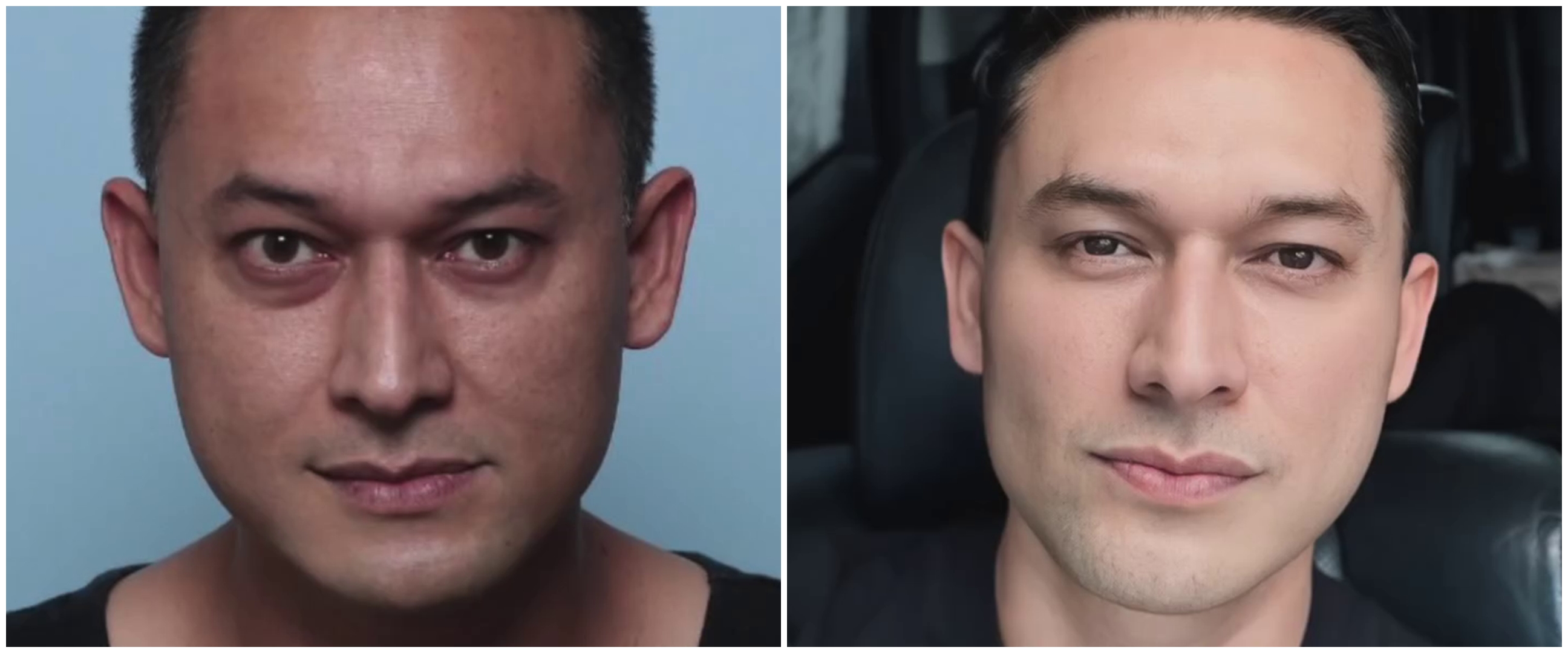 Mata cekung karena hipertiroid, 9 potret Indra Bruggman usai oplas ini dipuji makin tampan