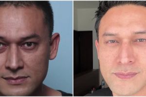 7 Transformasi Indra Bruggman sebelum dan setelah operasi area bawah mata, tampil fresh awet muda