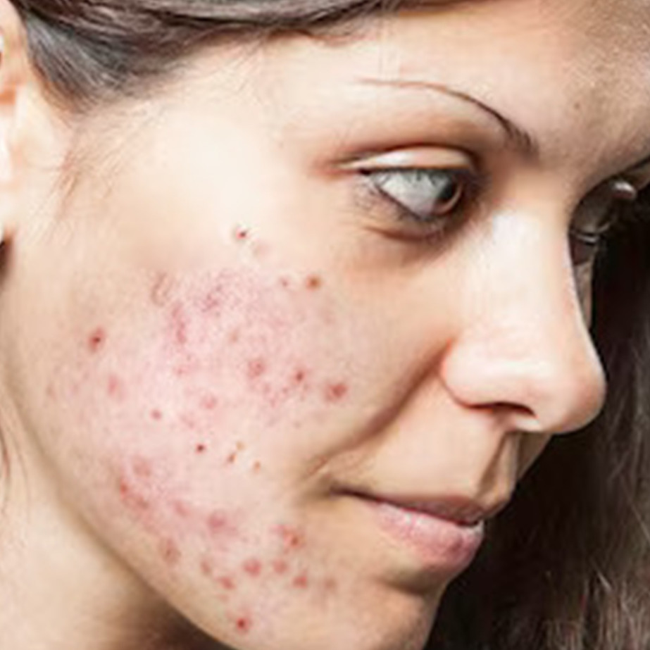 Cara mudah hilangkan bekas jerawat dan bintik hitam di wajah pakai 1 jenis buah