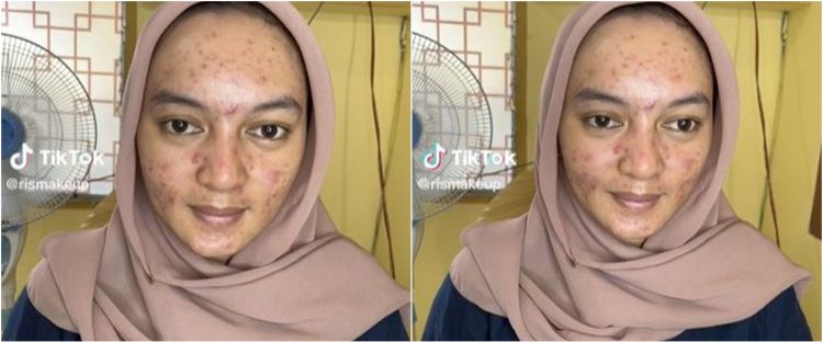 Bikin lupa paras aslinya, wajah wanita penuh jerawat dirias MUA hasilnya jadi mirip Citra Kirana