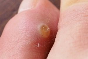 Cara mudah hempaskan mata ikan cuma pakai 1 bumbu dapur, nggak perlu obat khusus