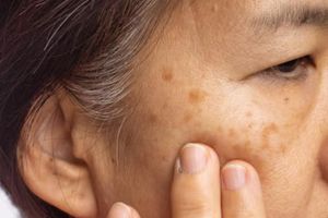 Cara memutihkan kulit dari flek hitam pakai 2 jenis minuman, hasilnya dikira tetangga suntik putih