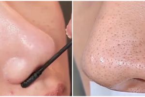 Tanpa perlu dibersihkan dengan pinset, cara menghilangkan komedo hitam ini bikin wajah lebih halus