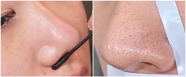 Tanpa perlu dibersihkan dengan pinset, cara menghilangkan komedo hitam ini bikin wajah lebih halus