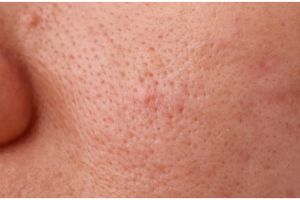 Cukup andalkan 1 jenis bunga, begini cara alami kecilkan pori-pori wajah tanpa merusak kulit