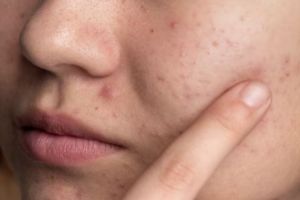 Cara menghilangkan beruntusan pakai masker dari 1 bahan pemanis, wajah mulus bebas gradakan