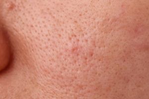 Cara membersihkan pori-pori tersumbat pakai 1 jenis minuman, wajah auto glowing dalam sekejap