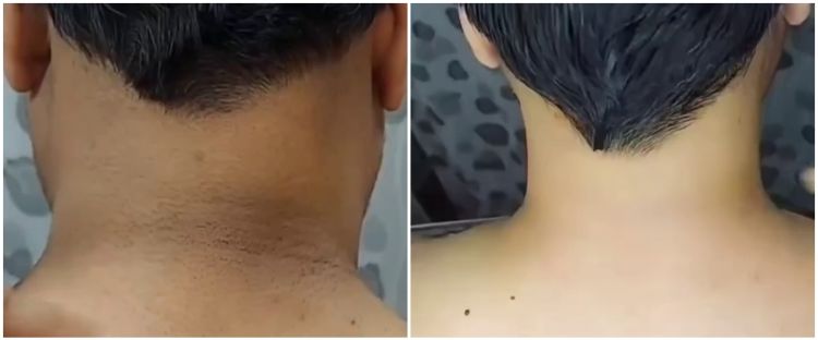 Cara mudah atasi punggung leher menghitam dan penuh lipatan ini auto mulus pakai 1 jenis minuman