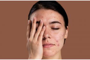 Ternyata ini cara hilangkan beruntusan dan jerawat tanpa perih, kulit mulus cuma pakai 1 ampas dapur