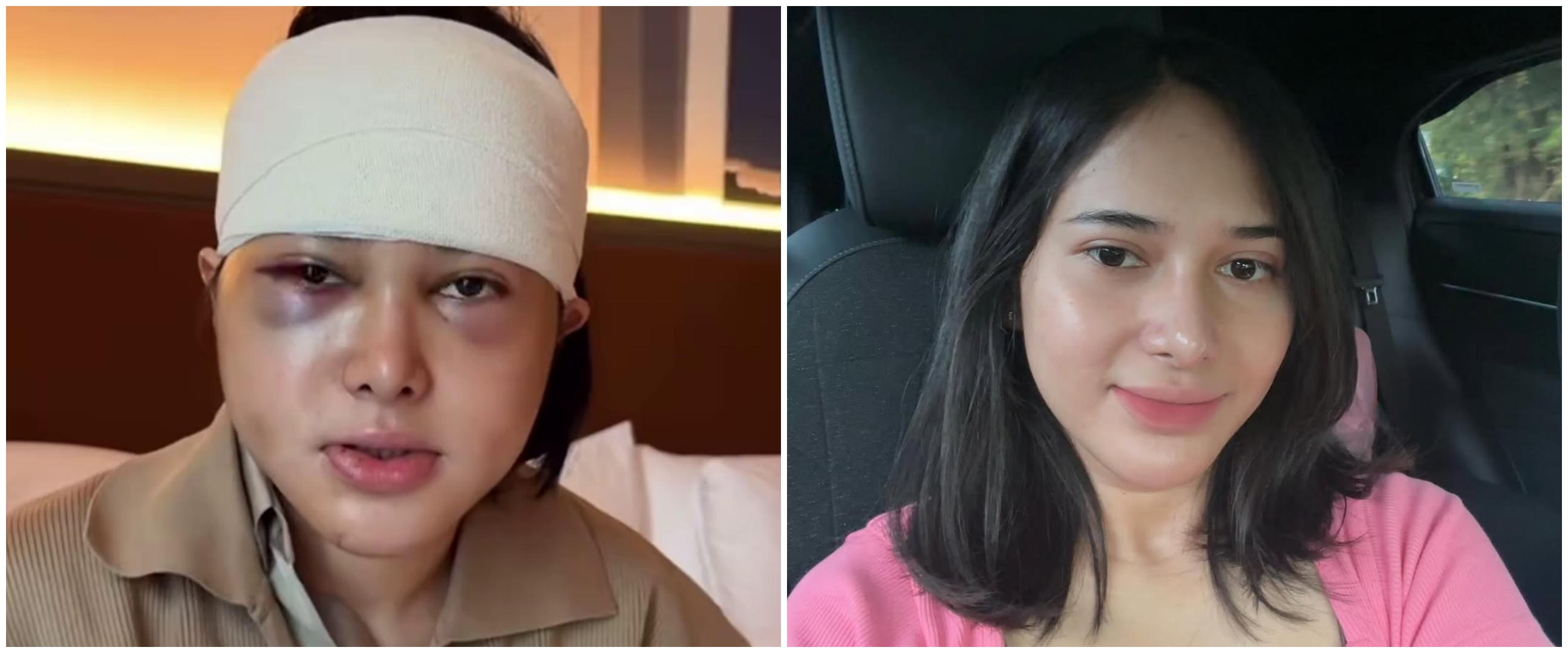9 Potret Dilan Janiyar seleb TikTok usai oplas di Korea, tak banyak berubah tetap cantik natural