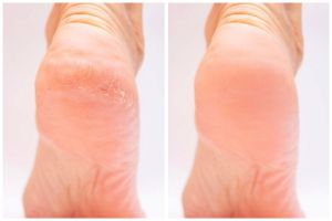 Tak perlu lotion khusus, ternyata getah buah ini bisa bantu atasi tumit pecah-pecah jadi lebih mulus