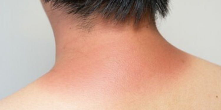 Bisa merata seperti sediakala, ternyata begini cara simpel pudarkan kulit belang pakai 1 jenis tepung