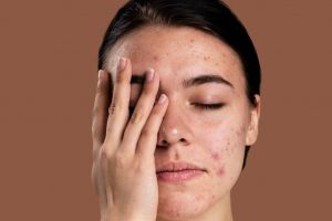 Ternyata begini cara atasi beruntusan di wajah pakai 1 jenis minuman, auto glowing dalam sekejap