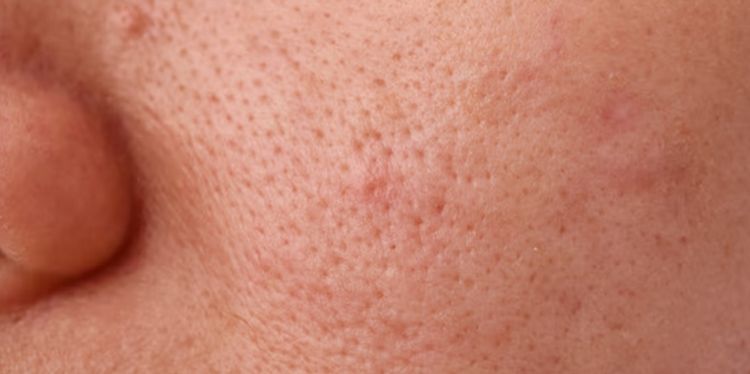 Ternyata begini cara bikin ukuran pori-pori mengecil pakai 2 jeni buah, wajah mulus bebas komedo