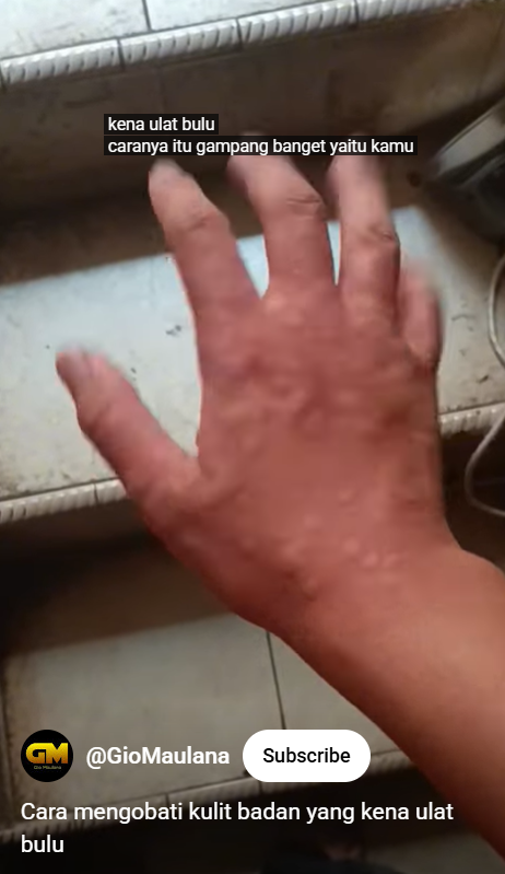 Trik agar kulit tak gatal dan nyeri usai digigit ulat bulu, sekarang atasi pakai 2 bahan dapur