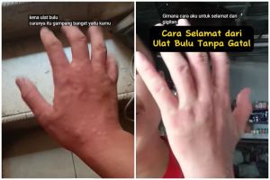 Trik agar kulit tak gatal dan nyeri usai digigit ulat bulu, sekarang atasi pakai 2 bahan dapur