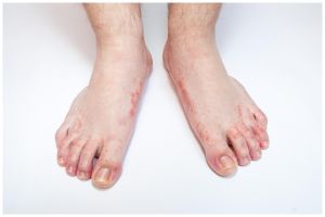 Bukan bawang putih, ternyata begini cara mengatasi infeksi jamur di kaki pakai 3 bahan dapur ini