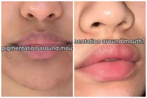 Area bibir gelap karena hiperpigmentasi? Ternyata ini cara mencerahkannya pakai 1 rempah dapur