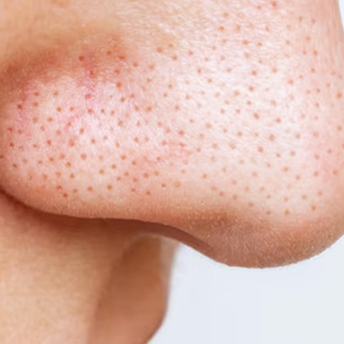 Trik mengecilkan pori-pori kulit agar tak mudah tersumbat pakai 1 sumber protein, wajah auto glowing