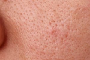 Cara simpel angkat komedo di pori-pori wajah pakai 2 jenis minuman, langsung bersih dala sekejap