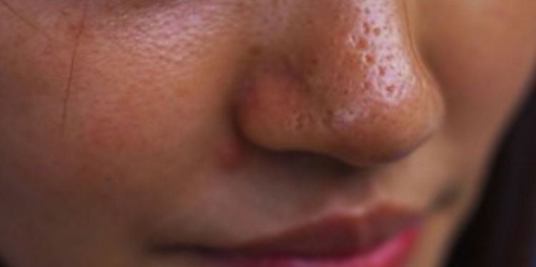 Cara bikin pori-pori rapat dan bersih cuma pakai 2 bahan dapur, wajah auto bak oplas