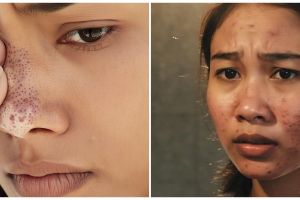 5 Cara cepat menghilangkan komedo hitam dan putih secara alami, wajah auto glowing