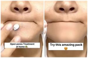 Kulit mulus tanpa iritasi, ini cara hilangkan komedo hitam dan bruntusan di dagu pakai 1 bahan pemanis