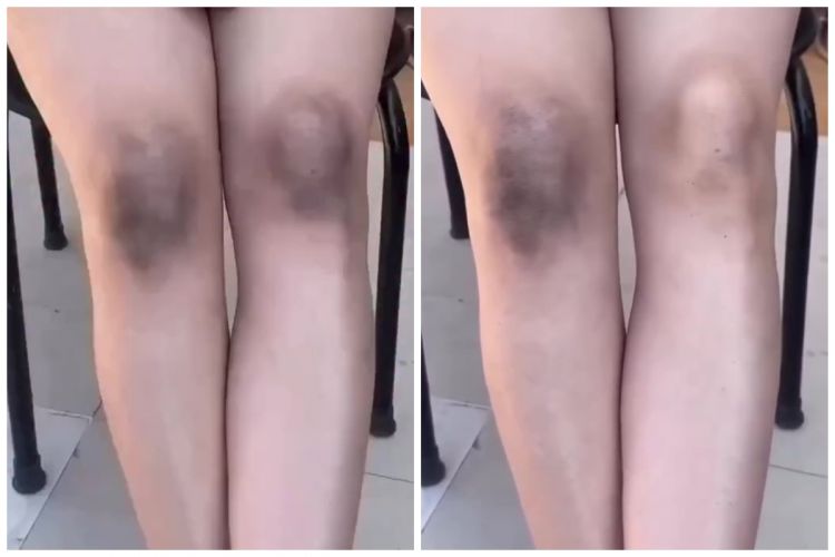 Cara eksfoliasi lutut gelap dan menghitam ini ampuh bikin cerah pakai scrub dari 3 bahan dapur