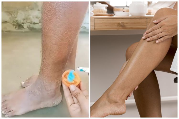 Kulit kering bikin pecah-pecah? Begini cara mengatasinya agar lembap cuma dengan 2 bahan dapur