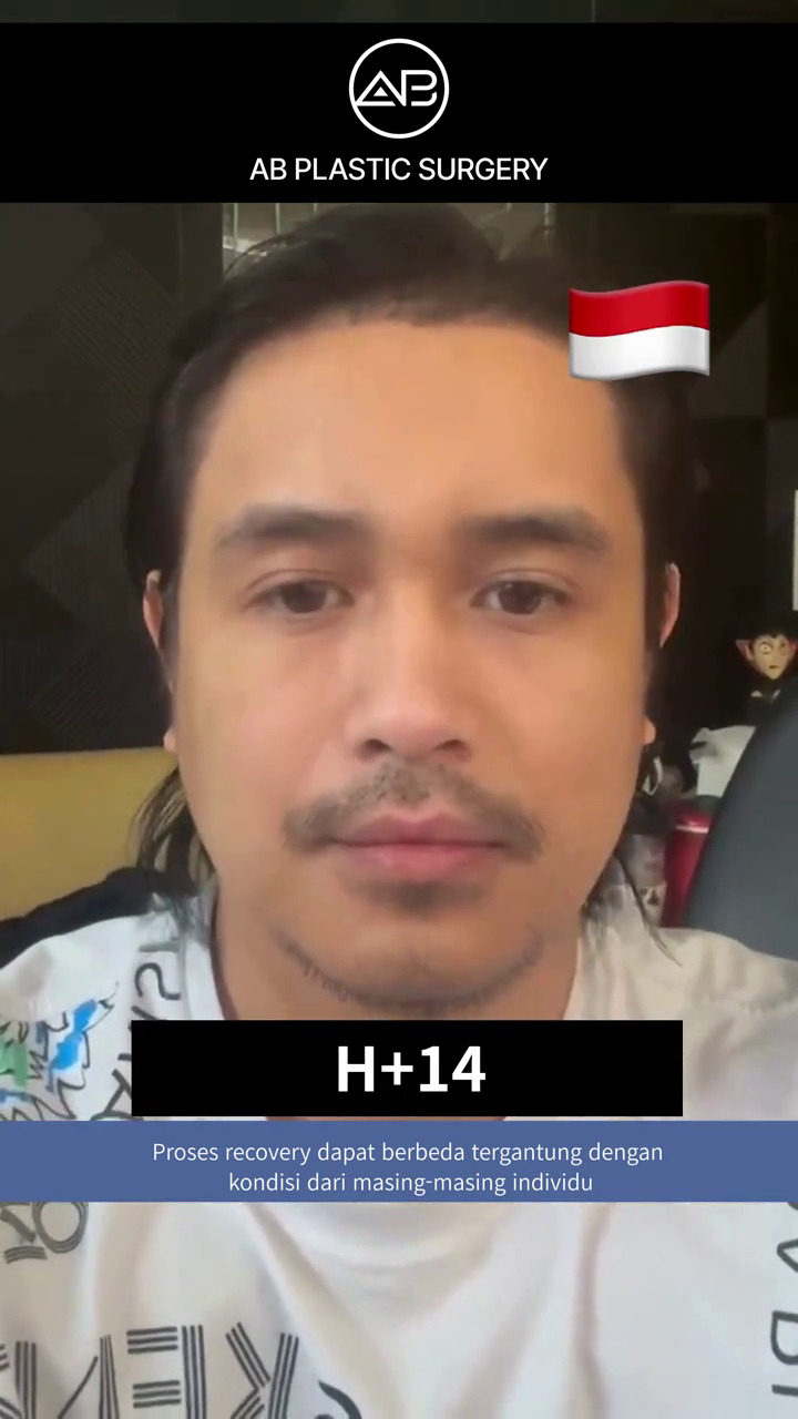 Wajah baru bikin salah fokus, ini 9 potret transformasi Ajun Perwira usai operasi plastik