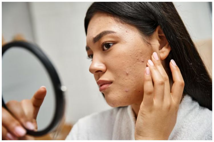 Cara baru atasi bruntusan secara alami pakai 2 bahan dapur, wajah halus bebas bintik kecil