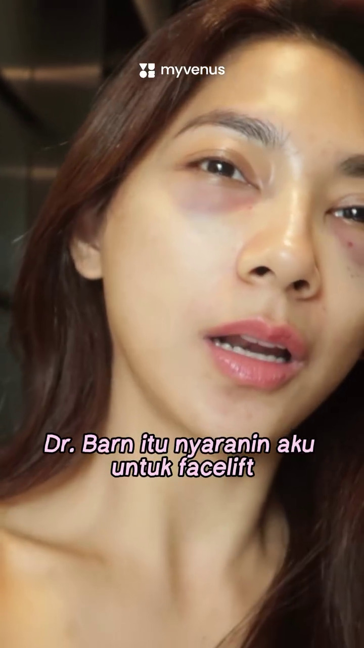 9 Transformasi Dinda Kirana jalani oplas wajah dan badan, hasilnya natural dan tampak lebih muda