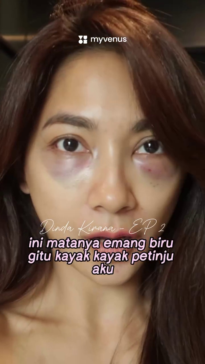 9 Transformasi Dinda Kirana jalani oplas wajah dan badan, hasilnya natural dan tampak lebih muda