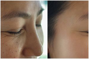 Hindari flek hitam akibat kosmetik bermerkuri, ini cara aman dan alami mengatasinya