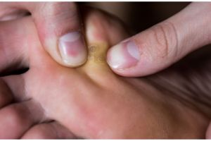 Cuma pakai bumbu dapur, mata ikan bisa hilang tanpa obat mahal dan batu apung