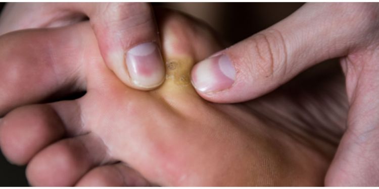 Cuma pakai bumbu dapur, mata ikan bisa hilang tanpa obat mahal dan batu apung