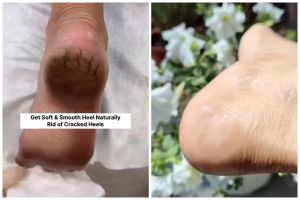 Tak perlu lotion khusus, sekarang tumit pecah-pecah bisa jadi mulus lagi cuma dengan 2 bahan dapur ini